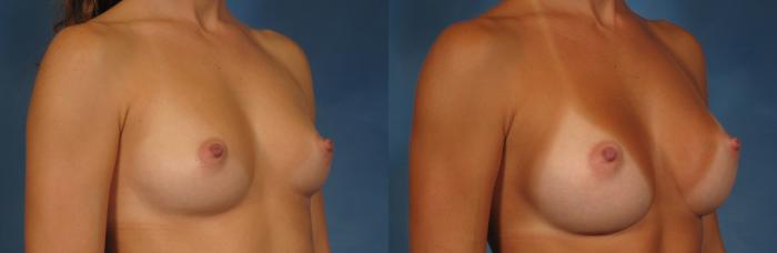 Before & After Breast Augmentation Case 250 View #3 View in Naples and Ft. Myers, FL