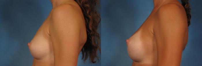 Before & After Breast Augmentation Case 250 View #4 View in Naples and Ft. Myers, FL