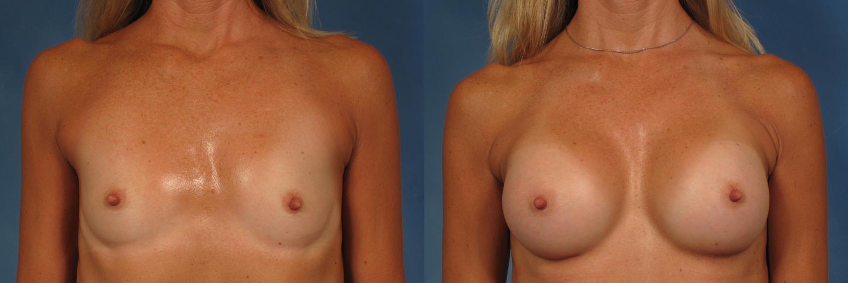 Before & After Breast Augmentation Case 258 View #1 View in Naples and Ft. Myers, FL