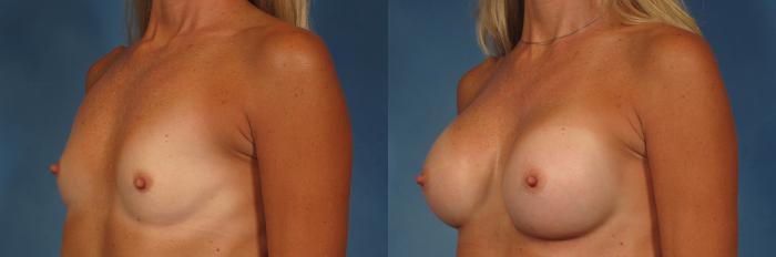 Before & After Breast Augmentation Case 258 View #2 View in Naples and Ft. Myers, FL