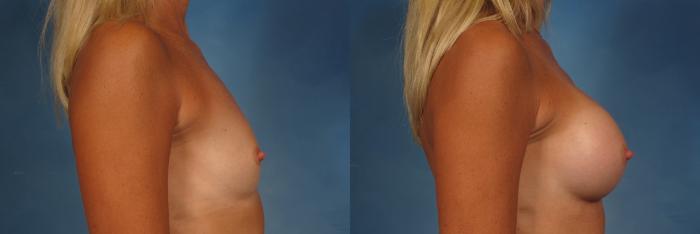 Before & After Breast Augmentation Case 258 View #3 View in Naples and Ft. Myers, FL