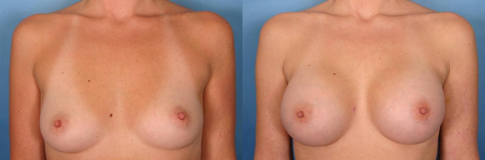 Before & After Breast Augmentation Case 29 View #1 View in Naples and Ft. Myers, FL