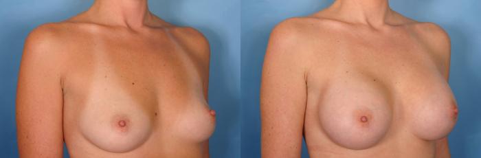 Before & After Breast Augmentation Case 29 View #2 View in Naples and Ft. Myers, FL