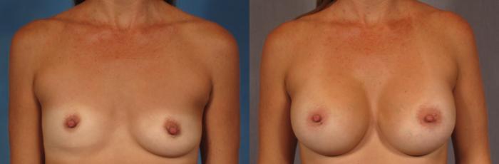 Before & After Breast Augmentation Case 294 View #1 View in Naples and Ft. Myers, FL