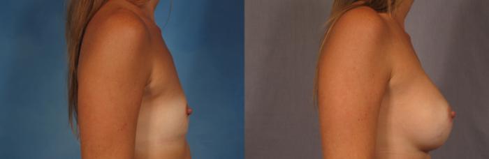Before & After Breast Augmentation Case 294 View #2 View in Naples and Ft. Myers, FL