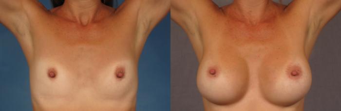 Before & After Breast Augmentation Case 294 View #4 View in Naples and Ft. Myers, FL