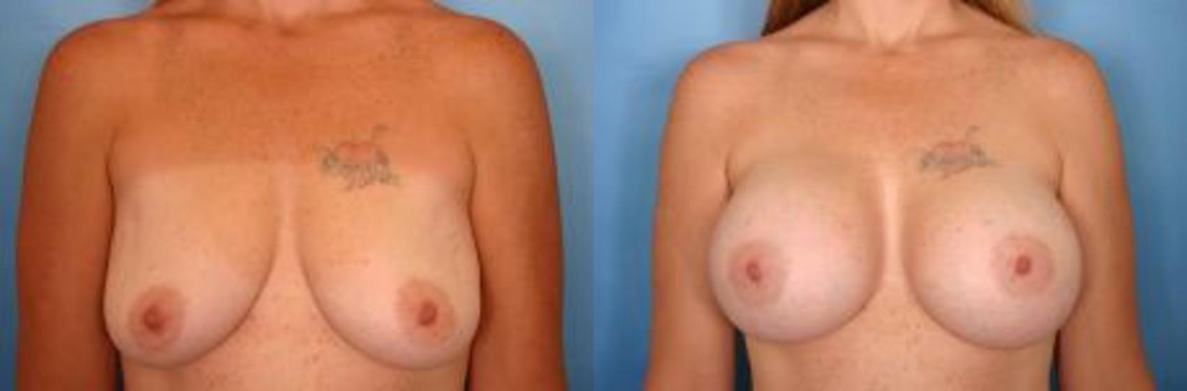 Before & After Breast Augmentation Case 3 View #1 View in Naples and Ft. Myers, FL