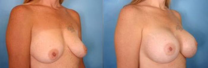 Before & After Breast Augmentation Case 3 View #2 View in Naples and Ft. Myers, FL