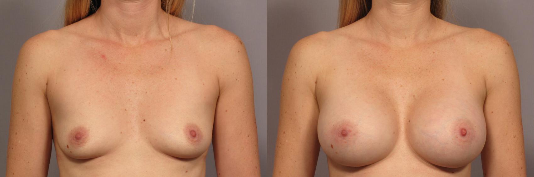 Before & After Breast Augmentation Case 322 View #1 View in Naples and Ft. Myers, FL
