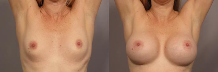 Before & After Breast Augmentation Case 322 View #2 View in Naples and Ft. Myers, FL