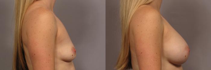 Before & After Breast Augmentation Case 322 View #3 View in Naples and Ft. Myers, FL