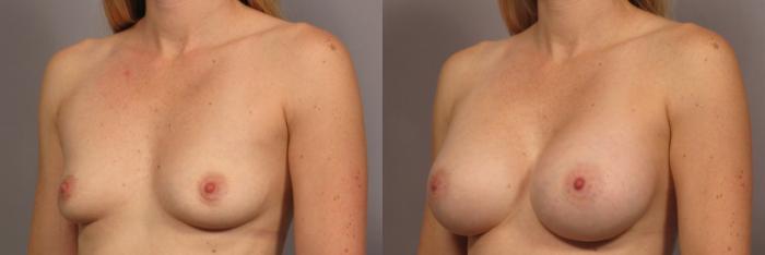 Before & After Breast Augmentation Case 322 View #4 View in Naples and Ft. Myers, FL