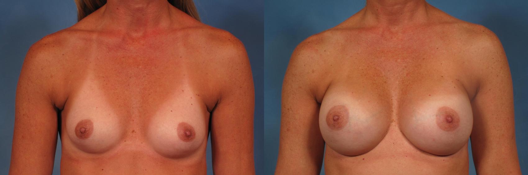Before & After Breast Augmentation Case 324 View #1 View in Naples and Ft. Myers, FL