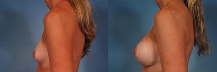 Before & After Breast Augmentation Case 324 View #3 View in Naples and Ft. Myers, FL