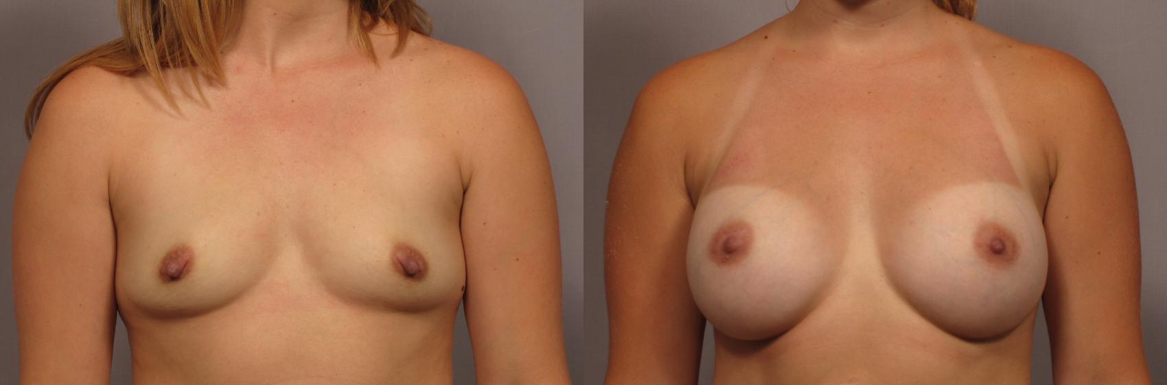 Before & After Breast Augmentation Case 337 View #1 View in Naples and Ft. Myers, FL
