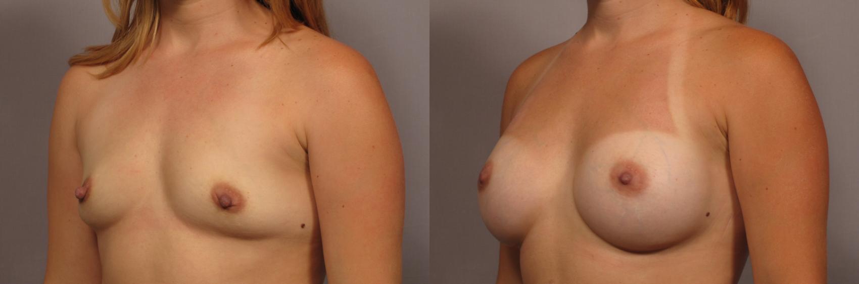 Before & After Breast Augmentation Case 337 View #2 View in Naples, FL