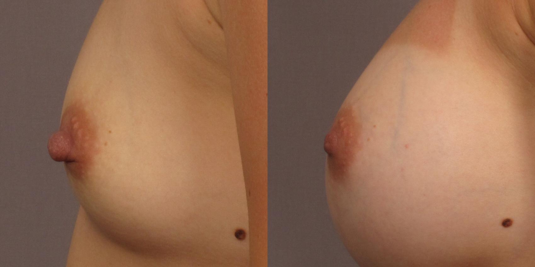 Before & After Breast Augmentation Case 337 View #3 View in Naples, FL
