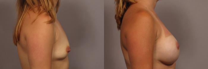 Before & After Breast Augmentation Case 337 View #4 View in Naples and Ft. Myers, FL