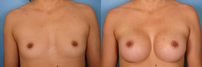 Before & After Breast Augmentation Case 35 View #1 View in Naples and Ft. Myers, FL