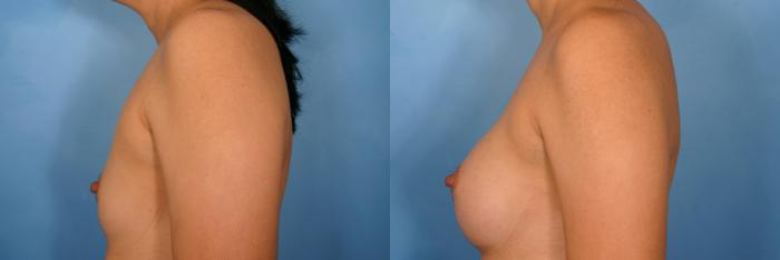 Before & After Breast Augmentation Case 35 View #2 View in Naples and Ft. Myers, FL
