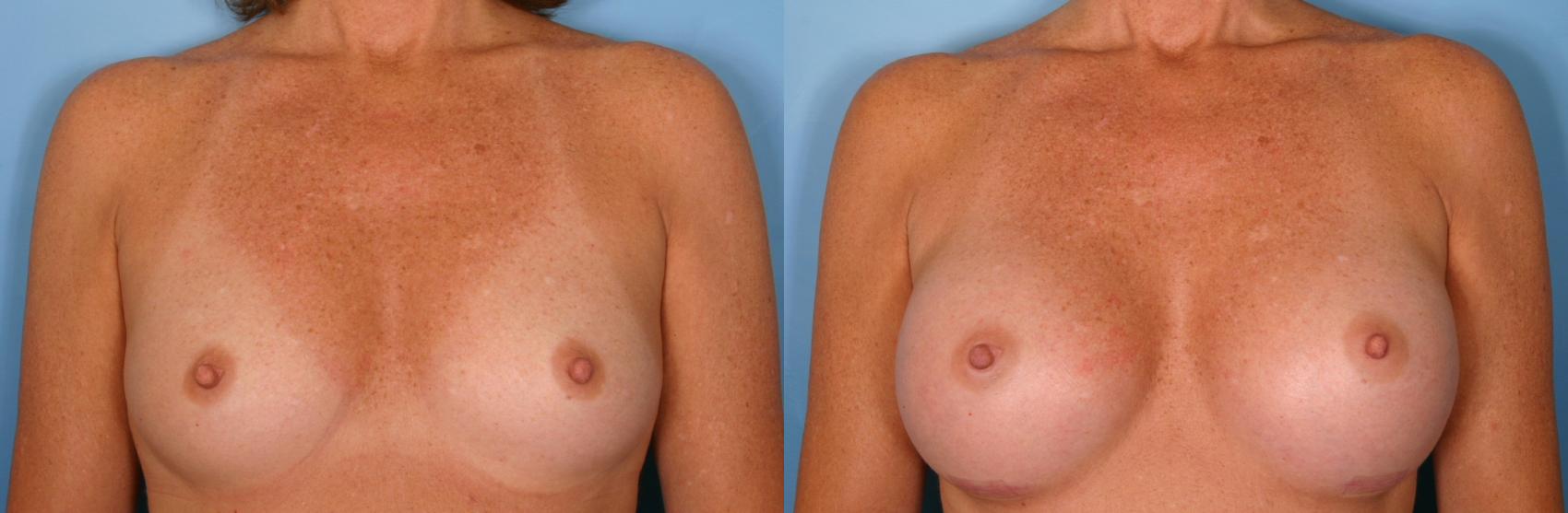 Before & After Breast Augmentation Case 36 View #1 View in Naples and Ft. Myers, FL