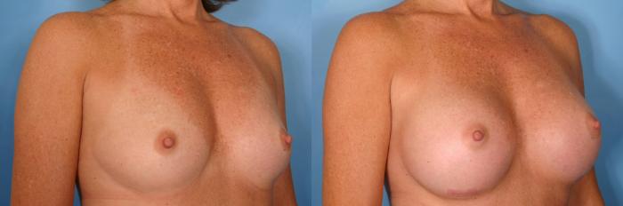 Before & After Breast Augmentation Case 36 View #2 View in Naples and Ft. Myers, FL