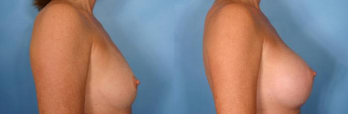Before & After Breast Augmentation Case 36 View #3 View in Naples and Ft. Myers, FL