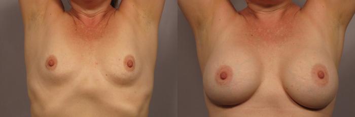 Breast Augmentation Photos from Front View (Arms Raised)