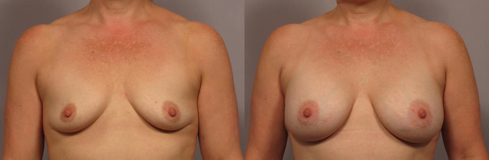 Breast Augmentation Photos from Front View