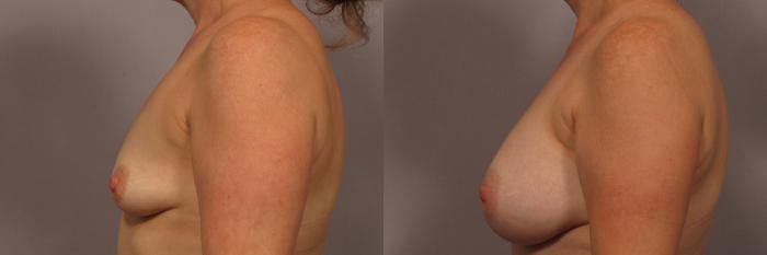 Side View of Breast Augmentation 1 Year Post Op