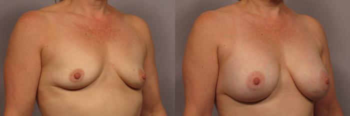 Silicone Breast Augmentation Oblique View