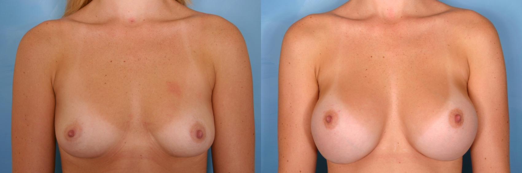 Before & After Breast Augmentation Case 37 View #3 View in Naples and Ft. Myers, FL