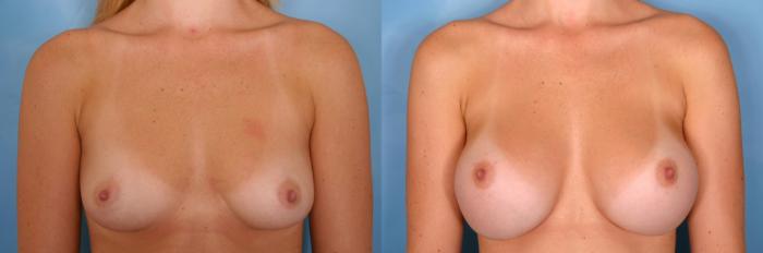 Before & After Breast Augmentation Case 37 View #3 View in Naples and Ft. Myers, FL