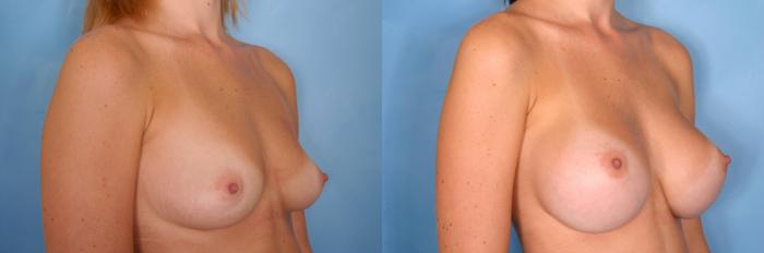 Before & After Breast Augmentation Case 37 View #4 View in Naples and Ft. Myers, FL