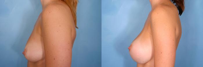 Before & After Breast Augmentation Case 37 View #5 View in Naples and Ft. Myers, FL