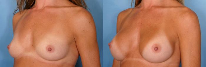 Before & After Breast Augmentation Case 38 View #3 View in Naples and Ft. Myers, FL