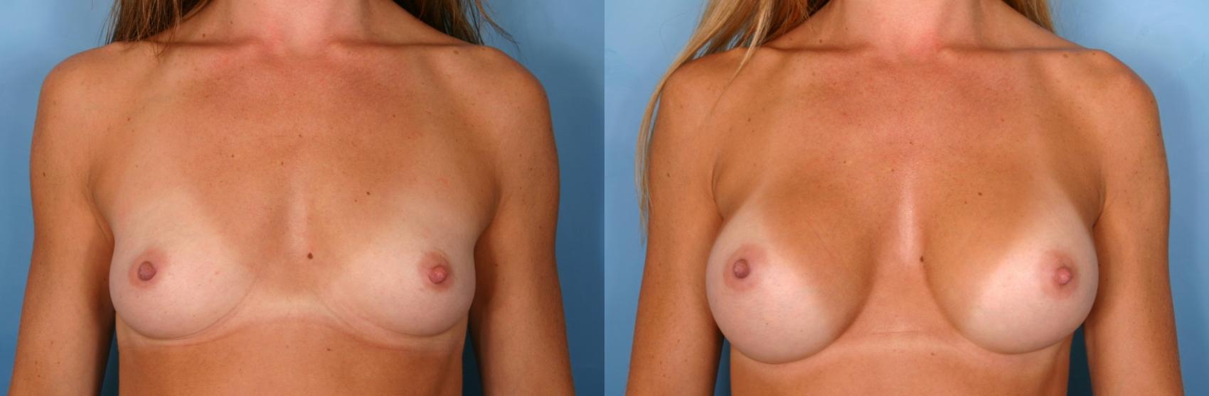 Before & After Breast Augmentation Case 38 View #4 View in Naples and Ft. Myers, FL