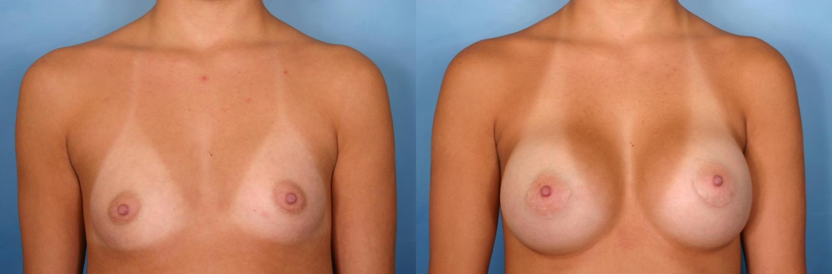Before & After Breast Augmentation Case 39 View #3 View in Naples and Ft. Myers, FL