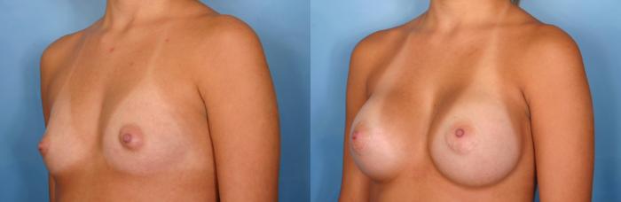 Before & After Breast Augmentation Case 39 View #4 View in Naples and Ft. Myers, FL
