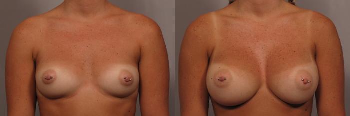 Frontal view of Naples Woman before getting silicone implants by Dr. Kent Hasen