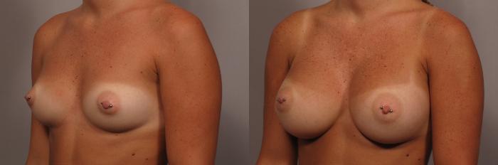Left Oblique view of Naples Woman before getting silicone implants by Dr. Kent Hasen