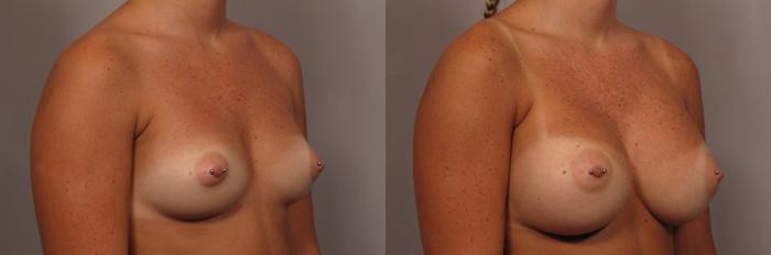 Right Oblique view of Naples Woman before getting silicone implants by Dr. Kent Hasen