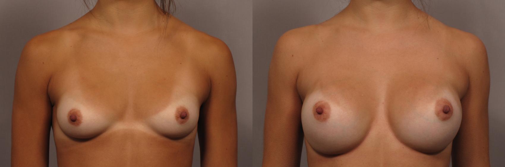 Front view of Dr. Kent Hasen Breast Augmentation with Silicone Implants, before