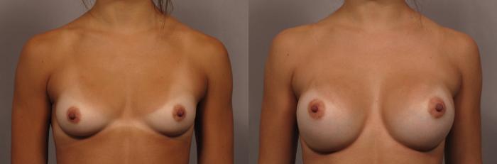 Front view of Dr. Kent Hasen Breast Augmentation with Silicone Implants, before