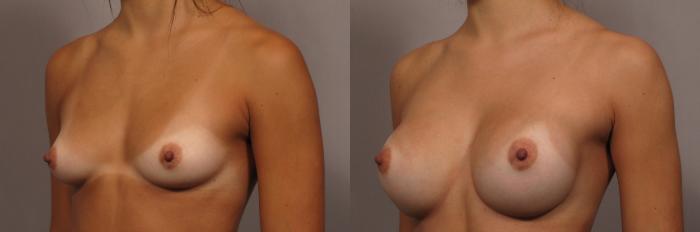 Left Oblique view of Dr. Kent Hasen Breast Augmentation with Silicone Implants, Before