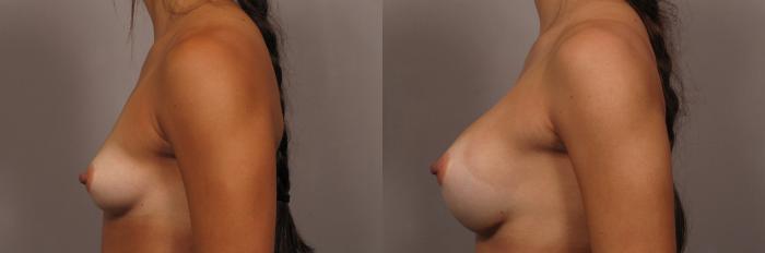 Left Side view of Dr. Kent Hasen Breast Augmentation with Silicone Implants, Before