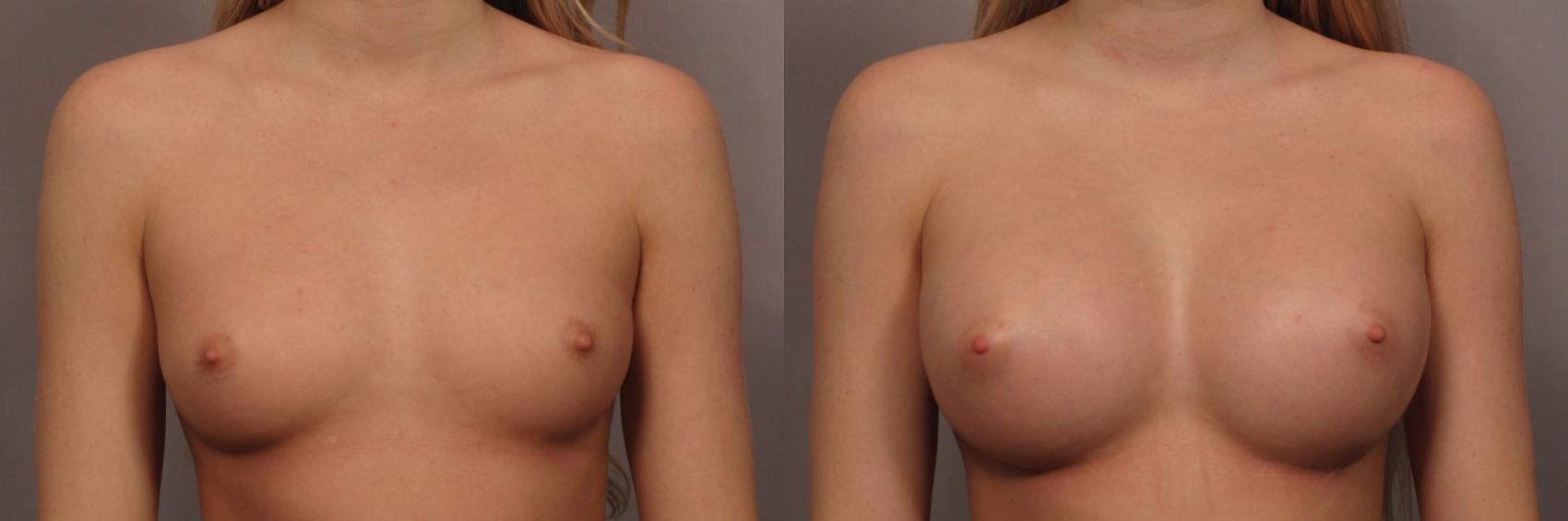 Kent Hasen医生用375毫升硅胶植入物隆胸的前视图