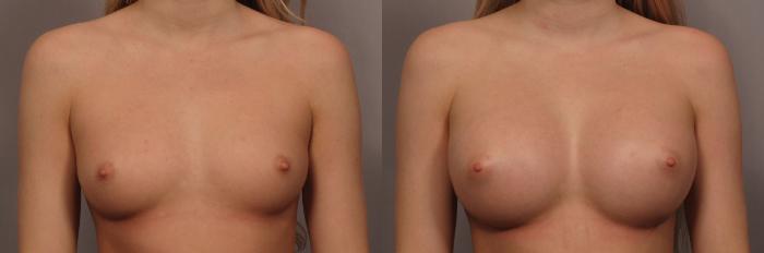Front view of Breast Augmentation by Dr. Kent Hasen with 375 cc Silicone Implants, Before
