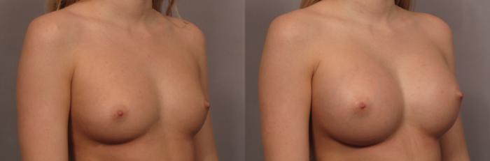 Right Oblique view of Breast Augmentation by Dr. Kent Hasen with 375 cc Silicone Implants, Before