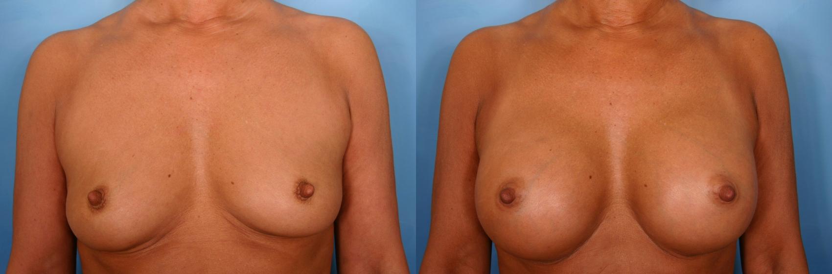 Before & After Breast Augmentation Case 40 View #1 View in Naples and Ft. Myers, FL